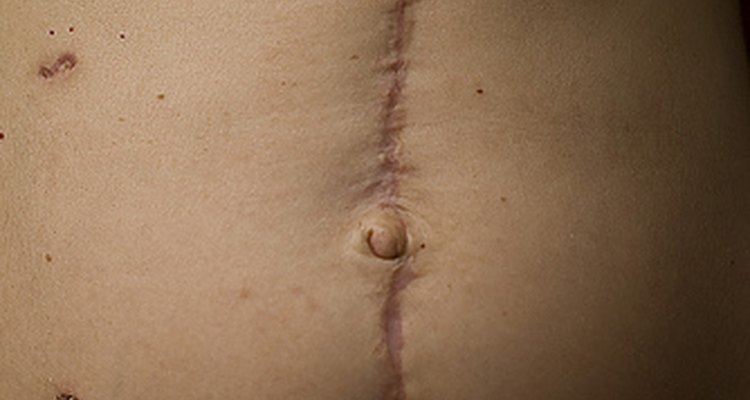 Large Abdominal Scar