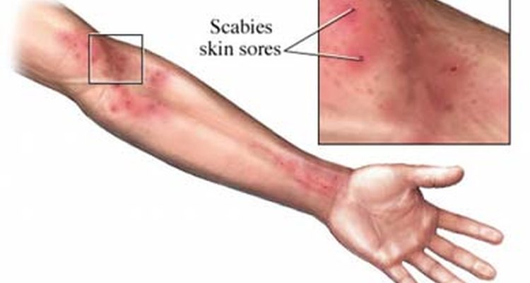 Identify scabies
