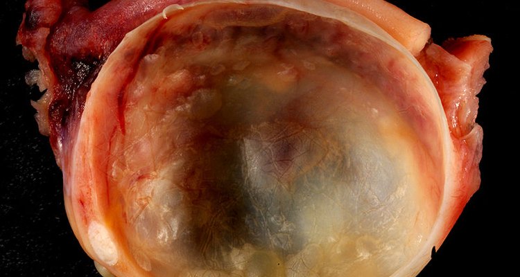 Ovarian Cyst