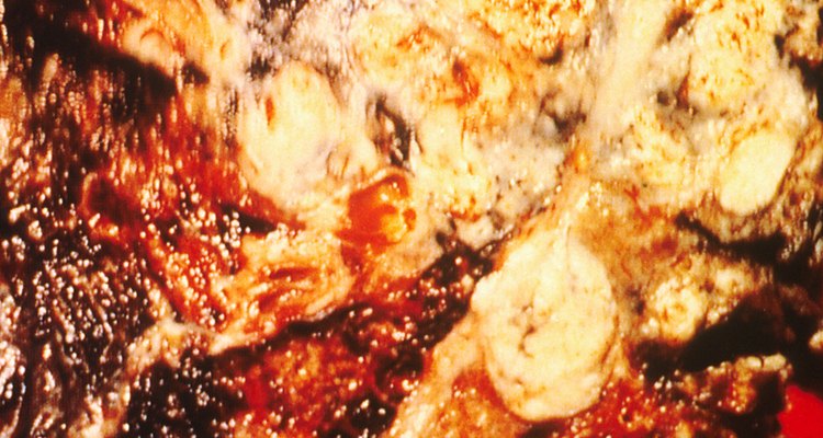 Cross-section of cancerous lung from a smoker (cancer.gov, public domain)