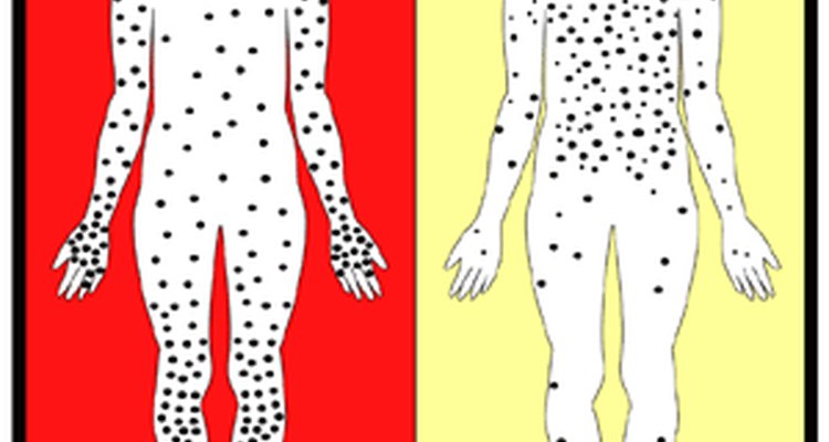 Difference in rash distribution between smallpox and chickenpox