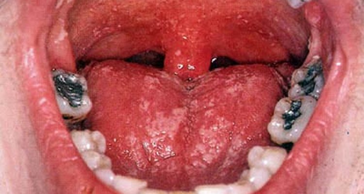Oral Thrust; http://www.medical-look.com/Mouth_diseases/Oral_thrush.html