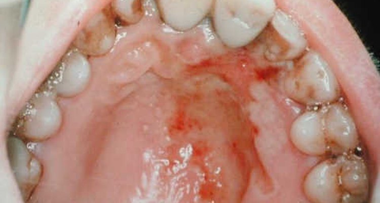 http://www.treatment-of-herpes.com/hotandtoparticles/some-herpes-pictures.html