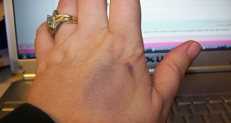 Marker bruise