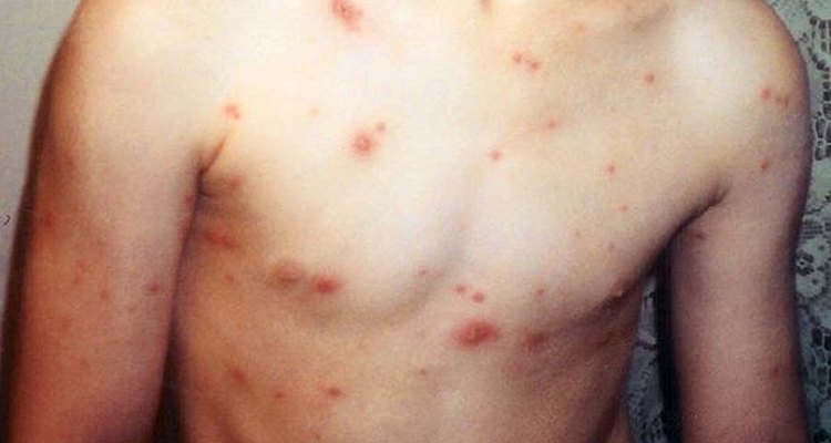 Chickenpox