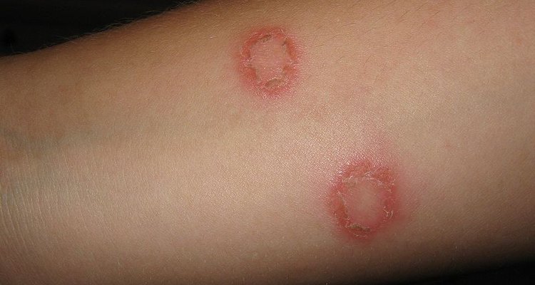 Ringworm