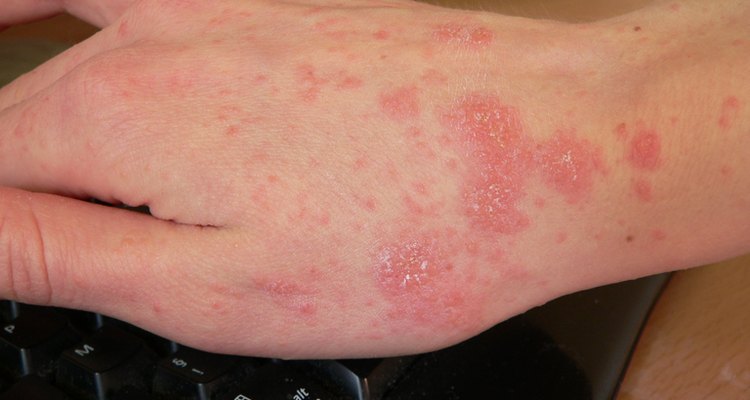 Scabies
