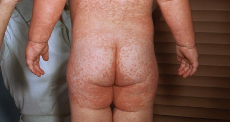 Measles