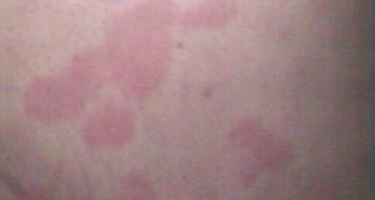 Hives