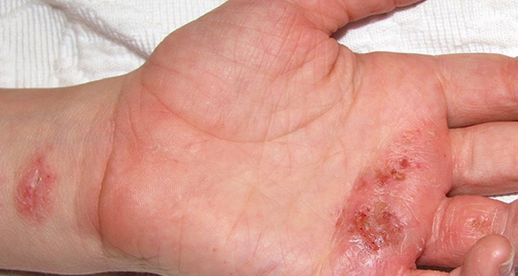 Impetigo