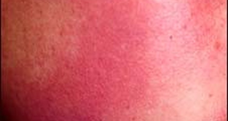 Here are some tips to treat keratosis pilaris.