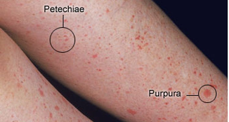 Petechiae or purpura on the skin is a sign of low platelets.