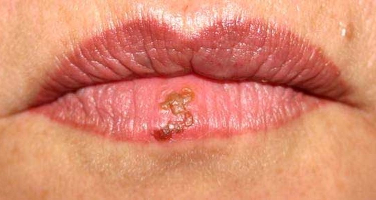 Cold sore scab