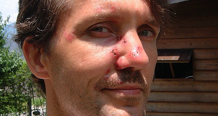 A patient using topical antibiotics.