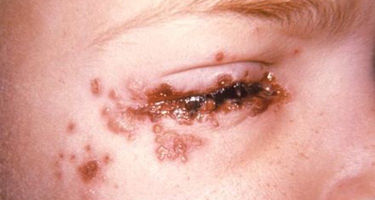 Herpes around the skin of the eye