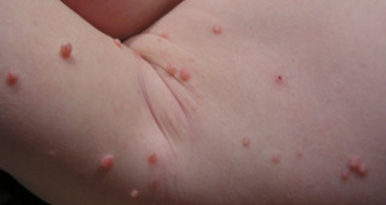 Molluscum contagiosum of the arm