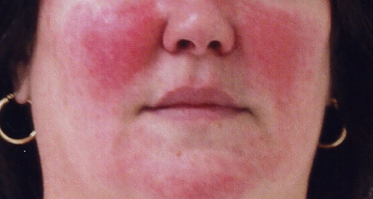 Rosacea