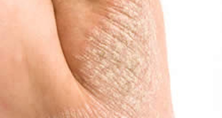 Eczema