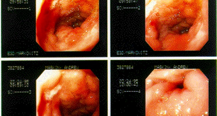Ulcer