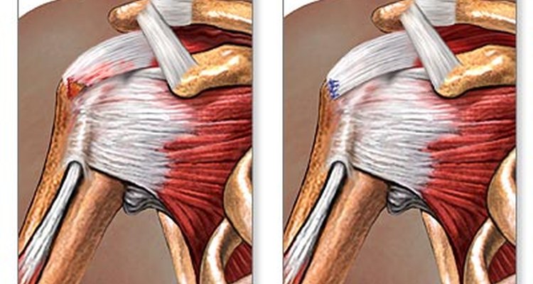 Comparação entre um manguito rotador lesionado e sua correção cirúrgica