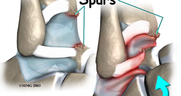 Bone Spurs