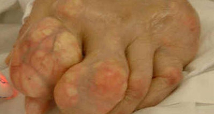 Gout in the foot can be both painful and disfiguring.
