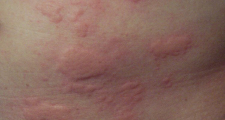 Hives credit: Enochlau wikimedia commons