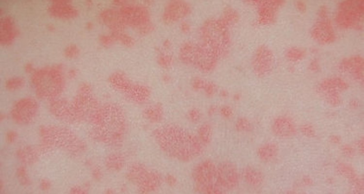 Medicine reaction credit: Skoch 3 wikimedia commons