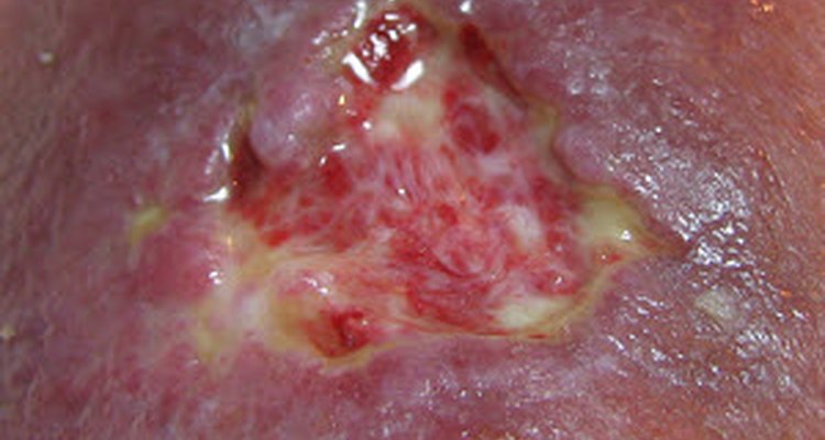 Dead tissue can result from strangulation.