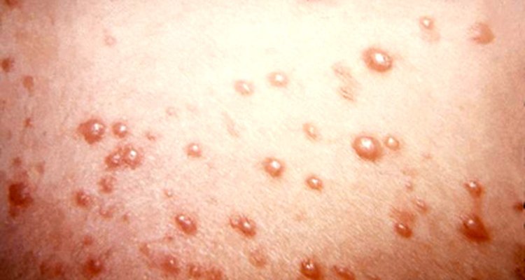 Chicken Pox