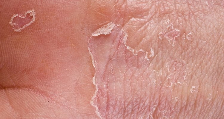 The causes for peeling of skin on your hands can be varried.