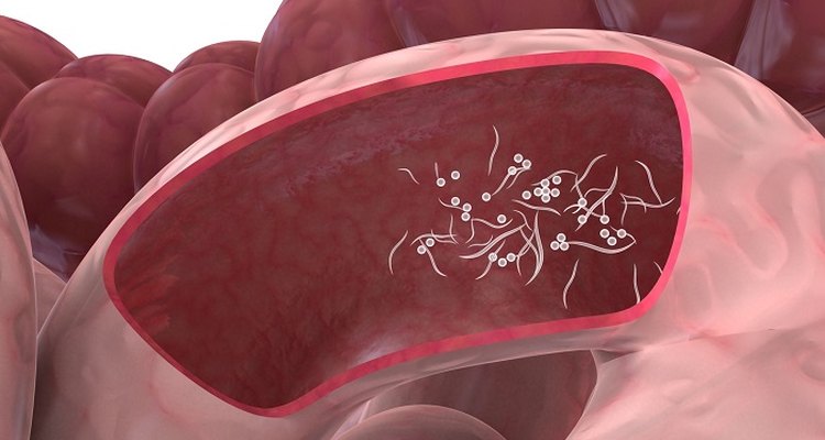 Pinworm instestinal infestations can be controlled easily.