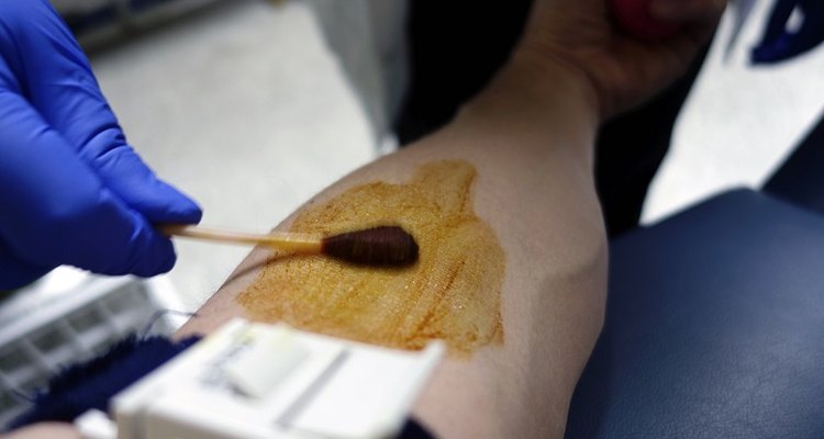 Iodine can easily spread from skin to clothes and leave a stain.