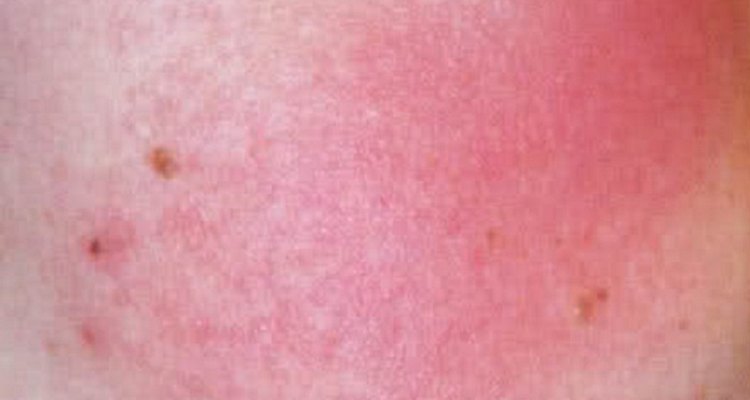 Keratosis pilaris rubra faceii causes a reddening of the cheeks.