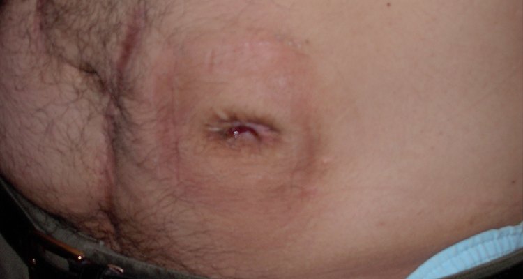 What Does a Normal Stoma Look Like?