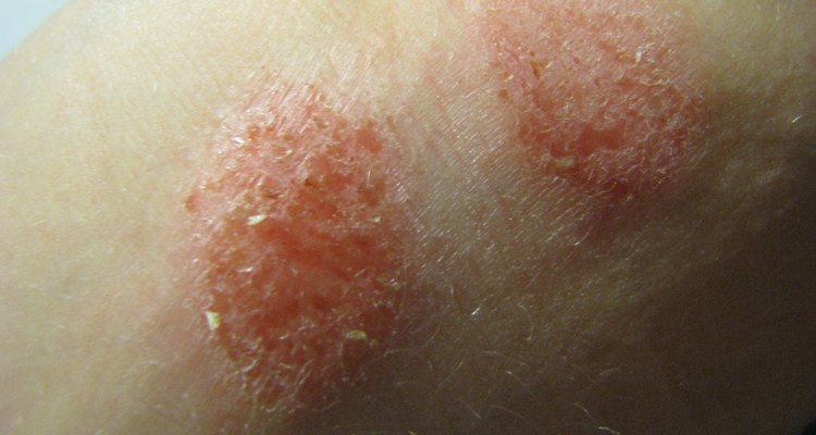 a-home-remedy-for-follicular-eczema