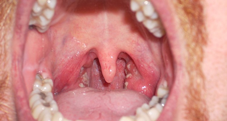 Does Strep Throat Make Your Tongue White