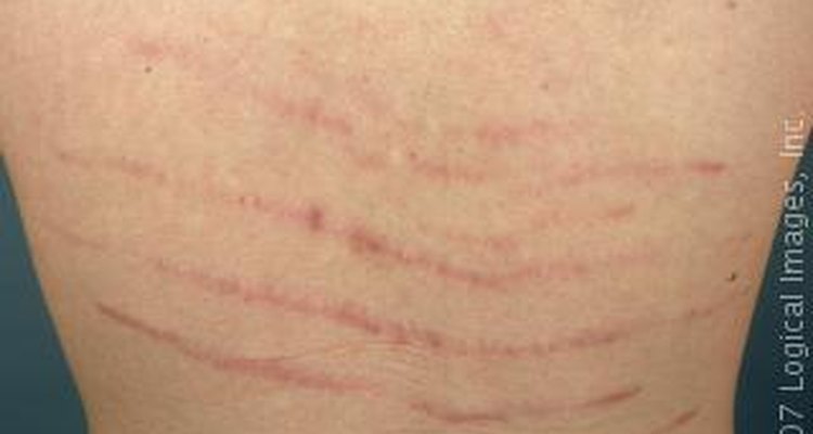 What causes stretch marks on the lower back?
