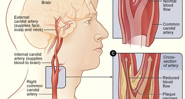 symptoms-of-blocked-neck-arteries