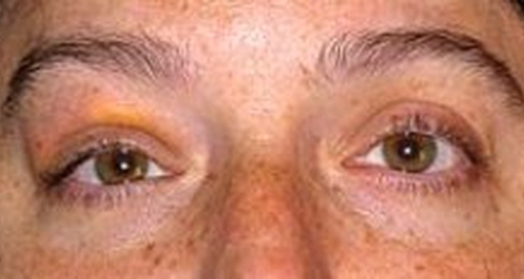 what-are-the-causes-of-eyelid-discoloration