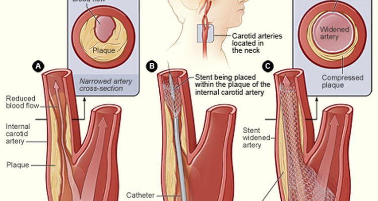 what-are-the-treatments-for-carotid-artery-blockage