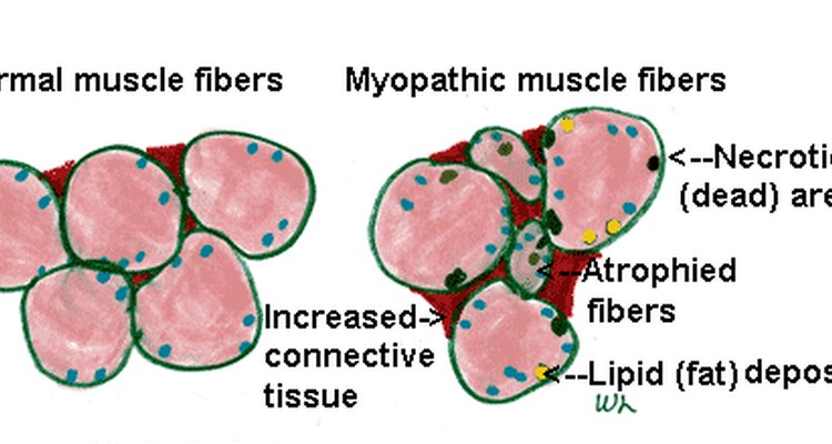 what-is-steroid-myopathy