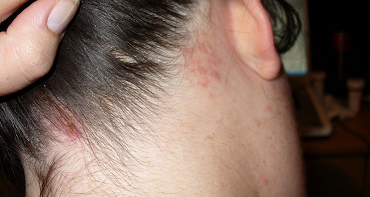 when-is-shingles-contagious