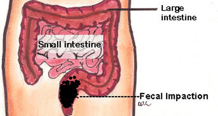 Can An Impacted Bowel Cause Hip Pain