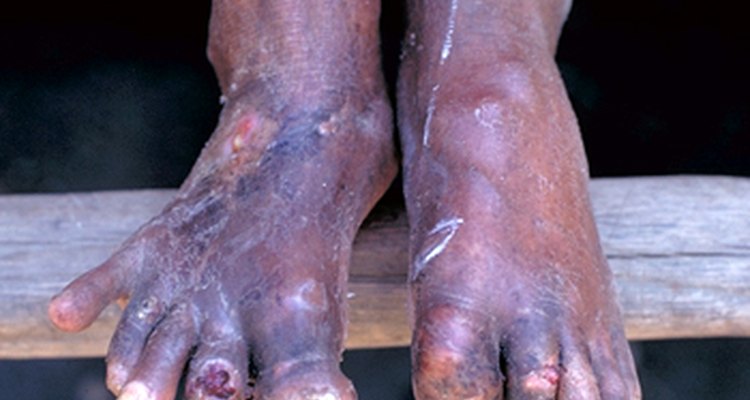 what is a home remedy for gout