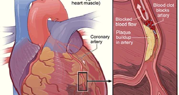 how-long-do-heart-attack-symptoms-last