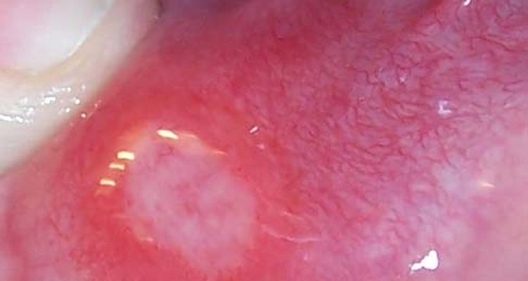 herpes-stomatitis-in-adults