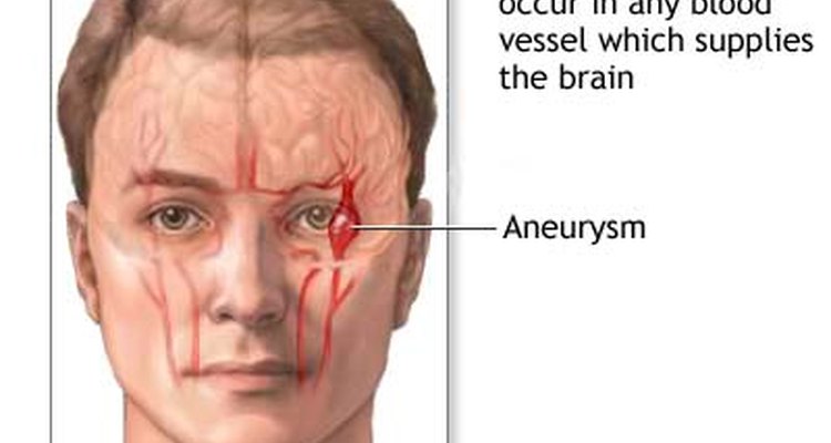 burst-blood-vessel-in-brain