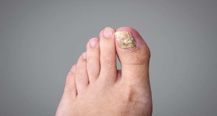 Infected toe treatment