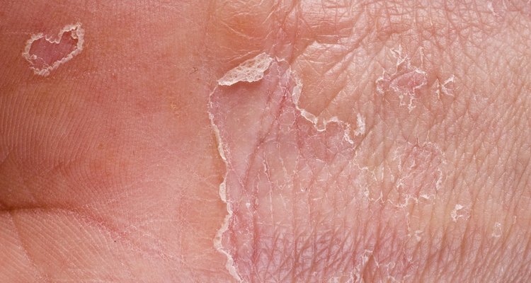 skin-peeling-on-fingertips-10-causes